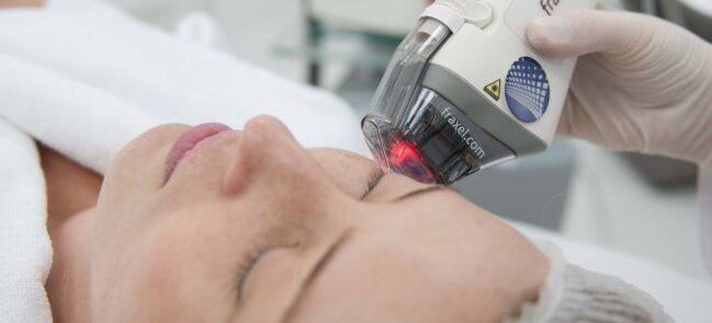 Resurfacing cutaneo frazionato con laser