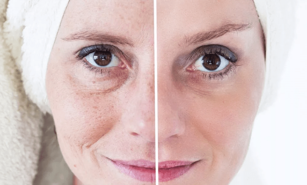 Ringiovanimento facciale laser